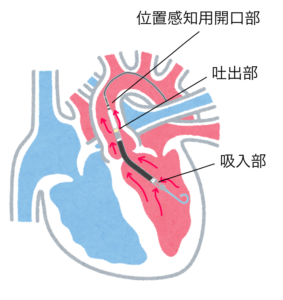 看護 Impella インペラ の特徴と管理のポイント