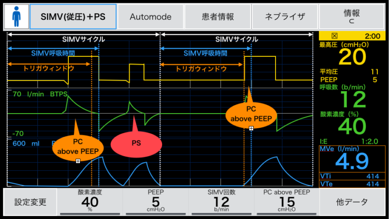 人工呼吸器のモード【SIMV】の動き方〜Servo i の場合〜